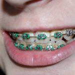 Aparelhos dentários