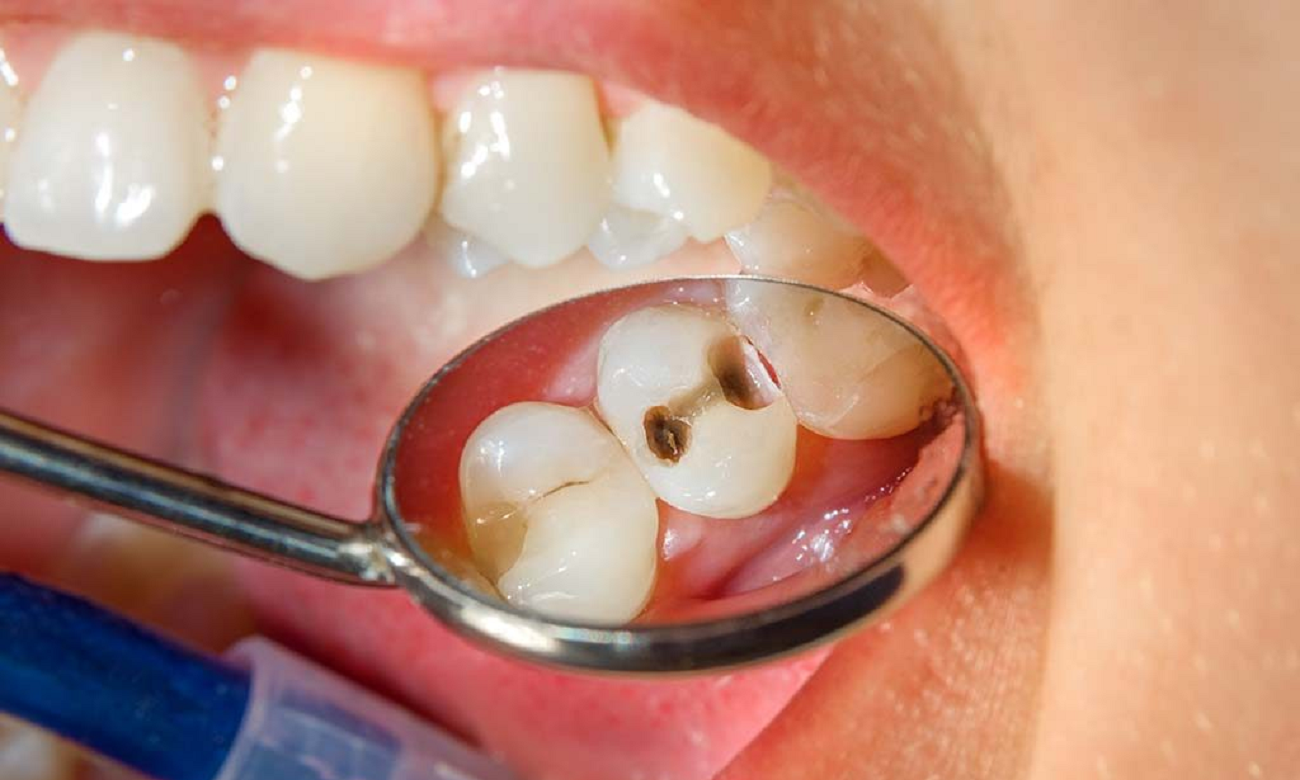 Cárie Dentária O Que é e Como Evitar? Zona Curiosa