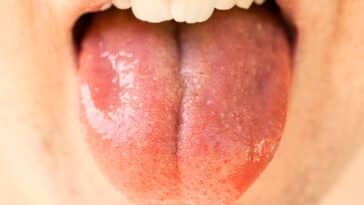 SALIVA CAPA