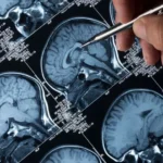 Alzheimer pode ser uma doenca autoimune Novo estudo da perspectivas diferentes para a doenca