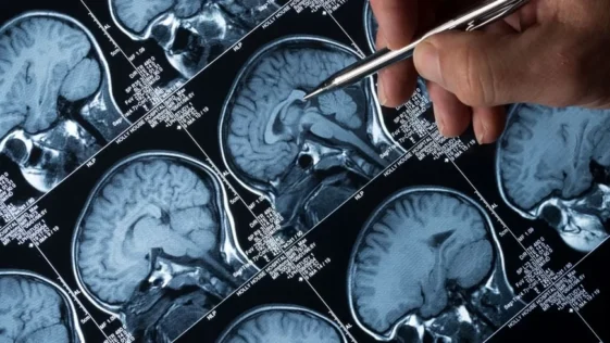 Alzheimer pode ser uma doenca autoimune Novo estudo da perspectivas diferentes para a doenca